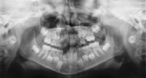 Dental Radiographs (X-Rays)
by Pediatric Dentistry of
Loveland in Loveland, CO