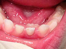 Double row of teeth